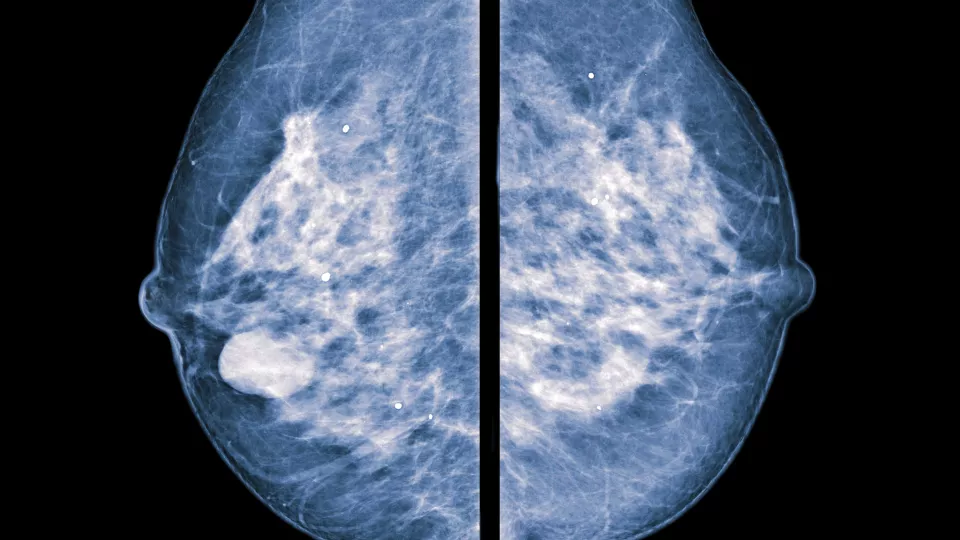 picture of breast tumor. photo.