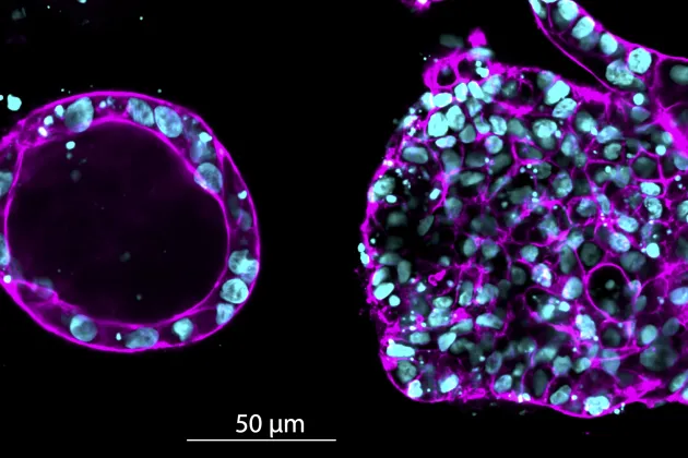 Fluorescence microscopy image showing cell clusters from breast tissue. On the left, tissue cultured in a soft gel; on the right, tissue cultured in a stiff gel. Photo: Kabilan Sakthivel 
