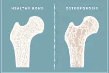 photo bone without and with osteoporosis. photo.