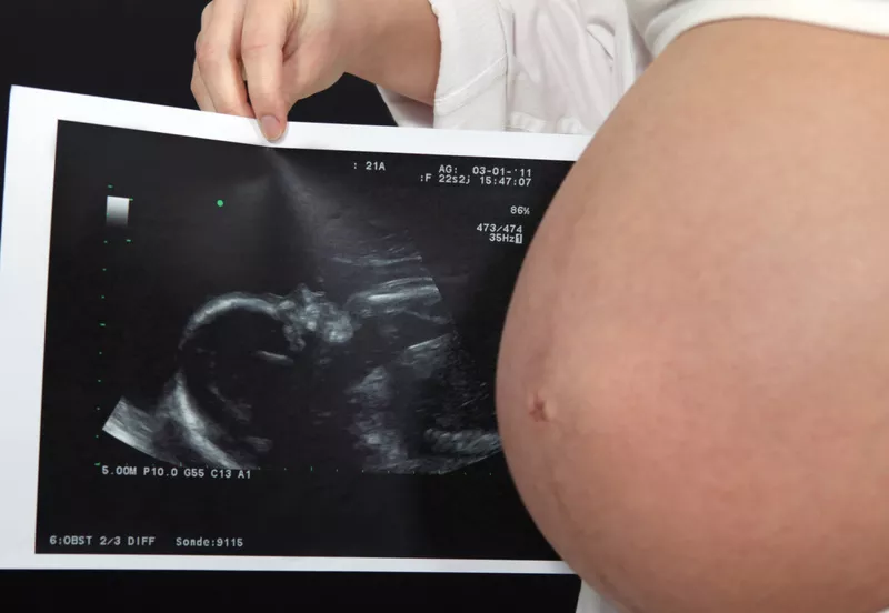 Ultrasound photo of foetus.